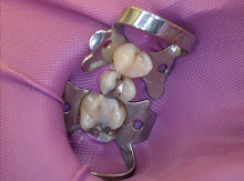 Kofferdamm w�hrend einer
                          Amalgamsanierung