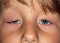 Eine Ptosis (herabhngendes
                            Augenlied) kann gut und gerne durch
                            Amalgam-Quecksilber verursacht sein, wenn
                            das Quecksilber die Nerven schdigt