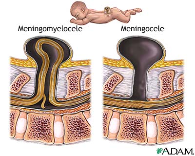 Spina bifida (offener Rcken),
                            Schema des Austritts des Rckenmarks aus dem
                            Rcken, der durch Quecksilberdmpfe whrend
                            der Schwangerschaft begnstigt wird. Die
                            Medizin will diesen Zusammenhang bis heute
                            nicht akzeptieren...