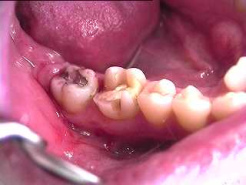 Backenz�hne mit
                            Amalgam. Das Quecksilber dringt in die
                            Zahnsubstanz hinein und von dort weiter in
                            den Kieferknochen, denn Z�hne sind nicht so
                            dicht, wie man allgemein meint