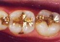 Goldf�llungen