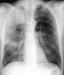 Lungenentz�ndung, R�ntgenfoto: Die
                            dauernde Aufnahme von Quecksilber durch
                            Amalgamf�llungen kann Resistenzen von Mund-
                            und Darmbakterien f�rdern und Resistenz
                            gegen�ber Antibiotika zur Folge haben. Die
                            Lungenentz�ndungen h�ufen sich, und die
                            Medizin "weiss nicht" warum, und
                            die Regierungen schlafen, weil ja sowieso
                            nur gesunde Menschen an der Regierung
                            sind...