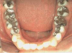 Amalgamgebiss mit Amalgam
in Seitenzähnen Amalgamgebiss mit Amalgam in
Seitenzähnen