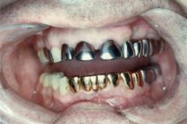 Amalgamgebiss mit
Frontzähnen aus Amalgam Amalgamgebiss mit Frontzähnen aus
Amalgam