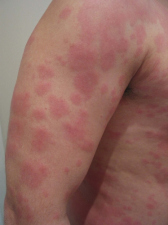 Urtikaria / Urticaria