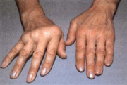 Chronische Polyarthritis
                          (Gelenkentz�ndung, Rheuma) mit Handskoliose