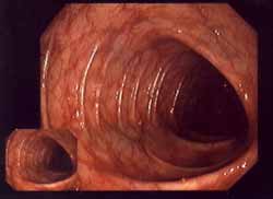 Ein
                          gesunder Darmkanal wird durch
                          Amalgam-Quecksilber belegt, und dadurch wird
                          die Darmflora derart geschw�cht, dass Pilze
                          und andere Erreger weniger abgewehrt werden,
                          und so k�nnen sich Pilze im Darm ausbreiten,
                          und diese Pilze lagern wiederum Schwermetalle
                          ein. Die Schul-"Medizin" und die
                          kriminellen, b�rsengeilen Regierungen wollen
                          es einfach nicht merken...