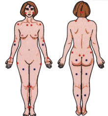 Fibromyalgie und Triggerpunkte, die
                          verh�rteten Stellen im Muskel- oder Zellgewebe
                          mit schmerzhaften Reaktionen durch irritierte
                          Nerven