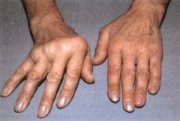 Poliartritis cr�nica
                        (artritis, reuma) con escoliosis de una mano. El
                        mercurio y la plata pueden - con su efecto
                        combinado - destruir la funci�n de c�lulas. El
                        sistema inmunol�gico pues tiene falsas
                        reacciones y destruye toda la c�lula en lugar de
                        eliminar solo los metales. As� se desarrollan
                        enfermedades autoinmunes y m�s enfermedades
                        graves. La medicina "convencional" no
                        quiere ver nada de eso, y los gobiernos
                        criminales y calientes de la bolsa dejan pagar
                        las cajas de salud para la amalgama y para los
                        medicamentos contra las secuelas...