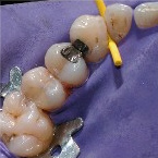 Kofferdamm f�r
                                              Amalgamsanierung:
                                              Amalgamsanierungen m�ssen
                                              unbedingt schrittweise und
                                              jeweils mit einem
                                              Kofferdamm ausgef�hrt
                                              werden, um das Einatmen
                                              von Quecksilber und
                                              Quecksilberd�mpfen zu
                                              vermeiden, sonst ist ein
                                              Nierenversagen nicht
                                              unwahrscheinlich