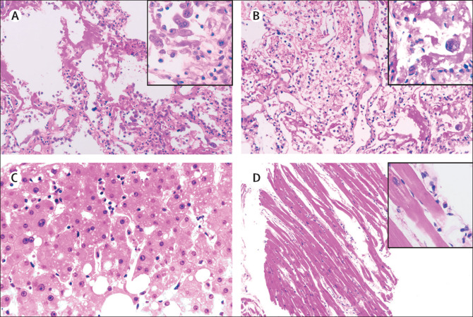 Italien, Corona19-Patient mit
                          Lungenschaden, Leberschaden und Herzschaden