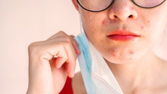 Die ganze
                      Mundpartie ist mit Pickeln �bers�t vom
                      Maskentragen