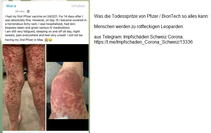 18.6.2021: PFIZER zerst�rt die
                        Gesellschaft: Menschen werden zu rotfleckigen
                        Leoparden