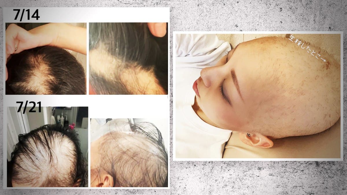 GENimpfschaden Haarausfall in der Schweiz
                    21.9.2021: Die Leute denken, die Person hat Krebs:
                    "Alle denken, ich h�tte Krebs": Immer mehr
                    F�lle von schwerem Haarausfall nach Impfung