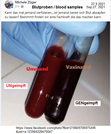 Medizinisches Blutbild 27.9.2021:
                    Normales Blut ist rot - Blut von GENgeimpften ist
                    dunkelbraun