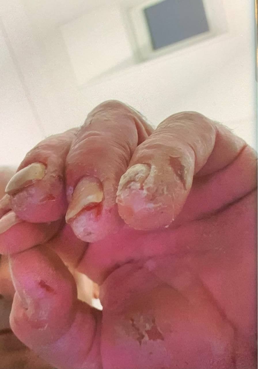 GENimpfschaden Schweiz 20.10.2021:
                          Kaputte Finger durch GENimpfung