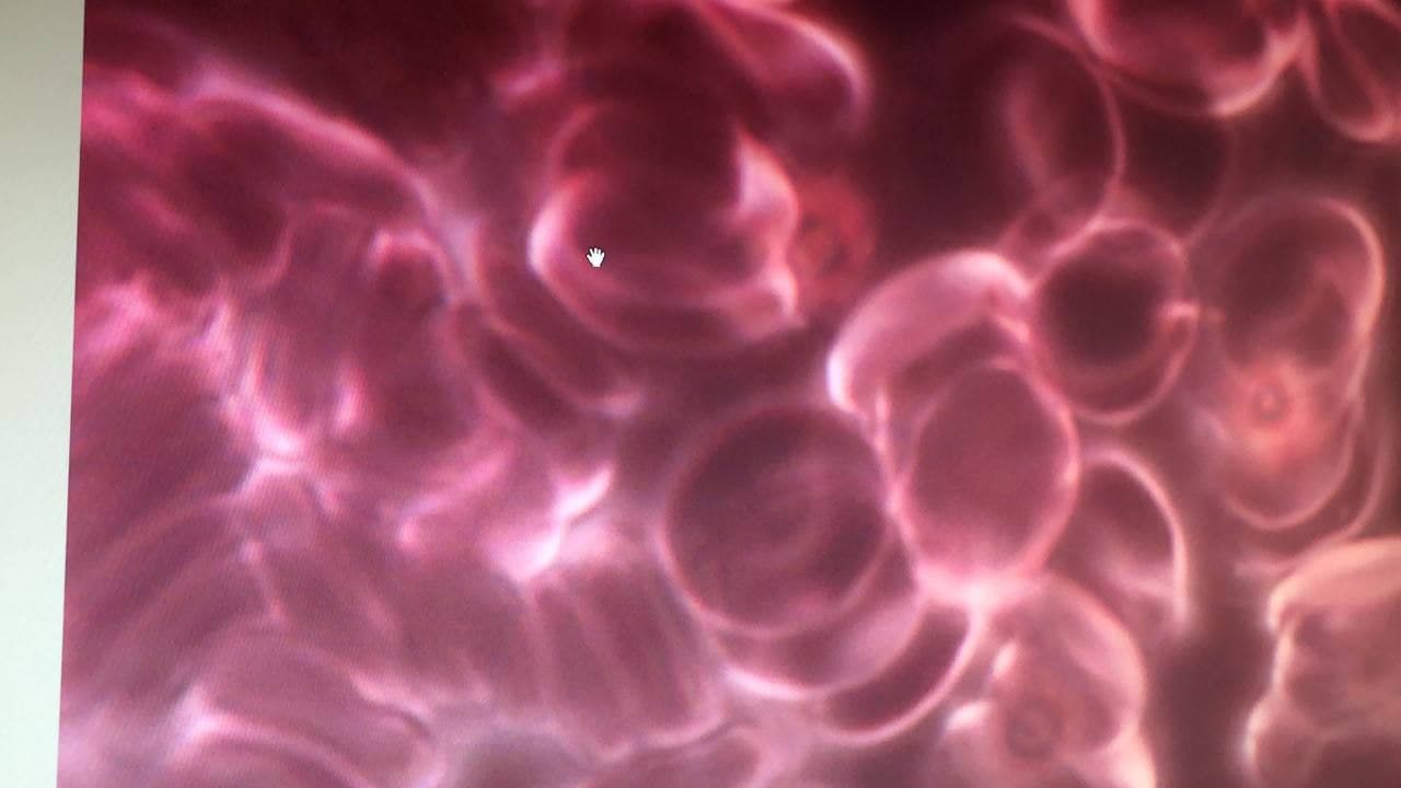 Blut kaputt nach
                        GENimpfung 6.11.2021: Die roten Blutk�rperchen
                        sind "gestapelt"