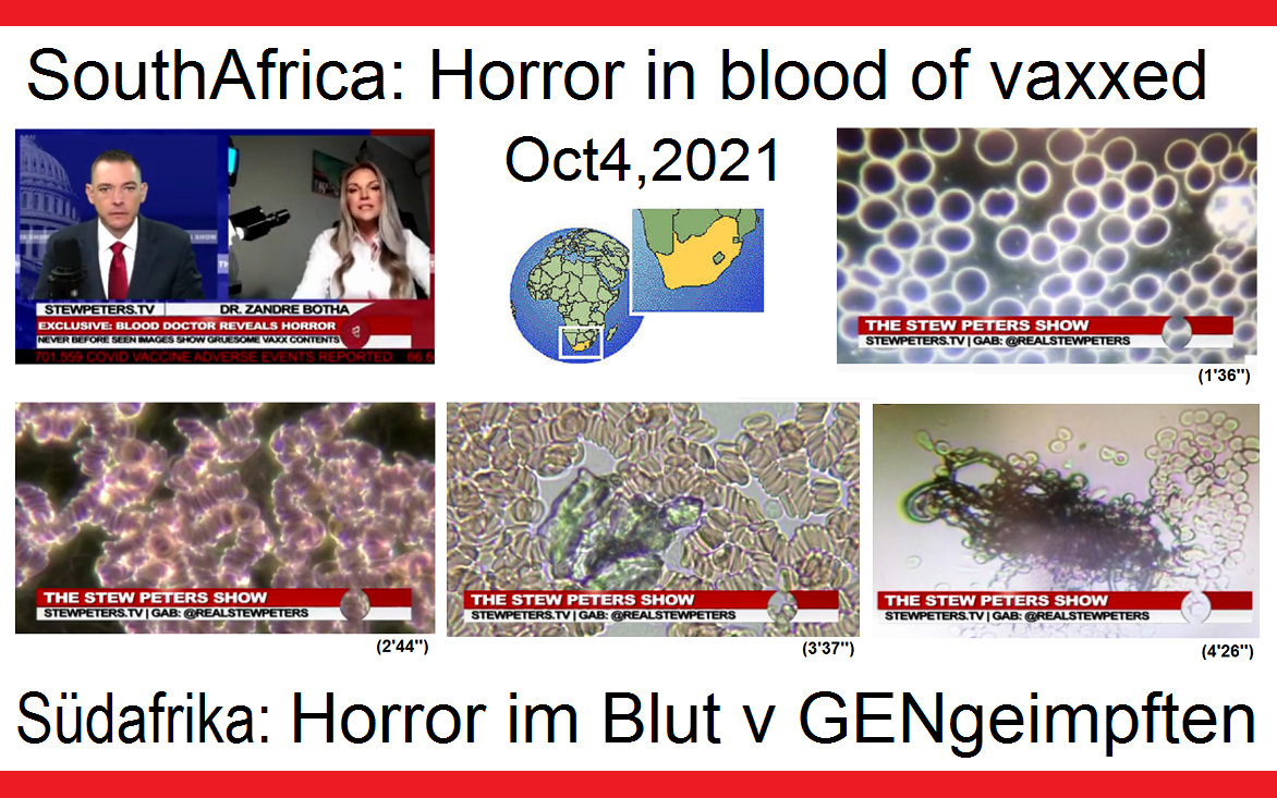 S�dafrika Dr. Zandre
                      Botha: Schlimme Blutbilder bei GENgeimpften mit
                      schweren Symptomen, 6.10.2021