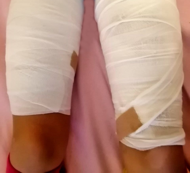 Fascho-�sterreich:
                    Kind (8) hat verbundene Oberschenkel - zVg Frau W.