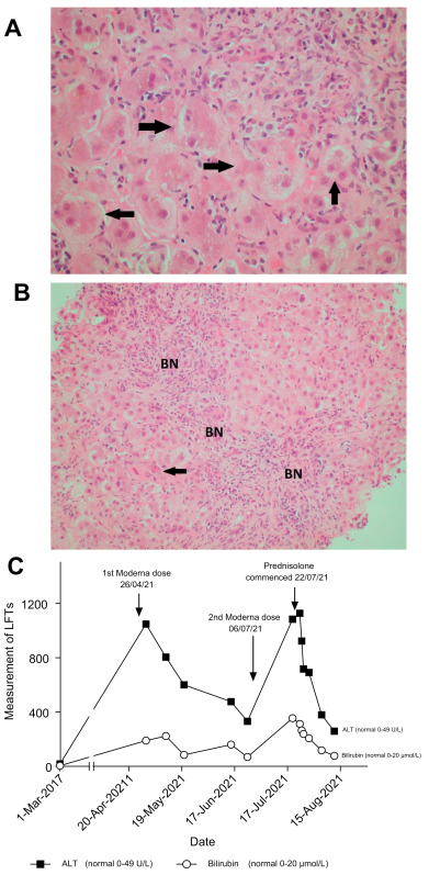Leberschaden Hepatitis
                            nach Moderna-GENimpfung
