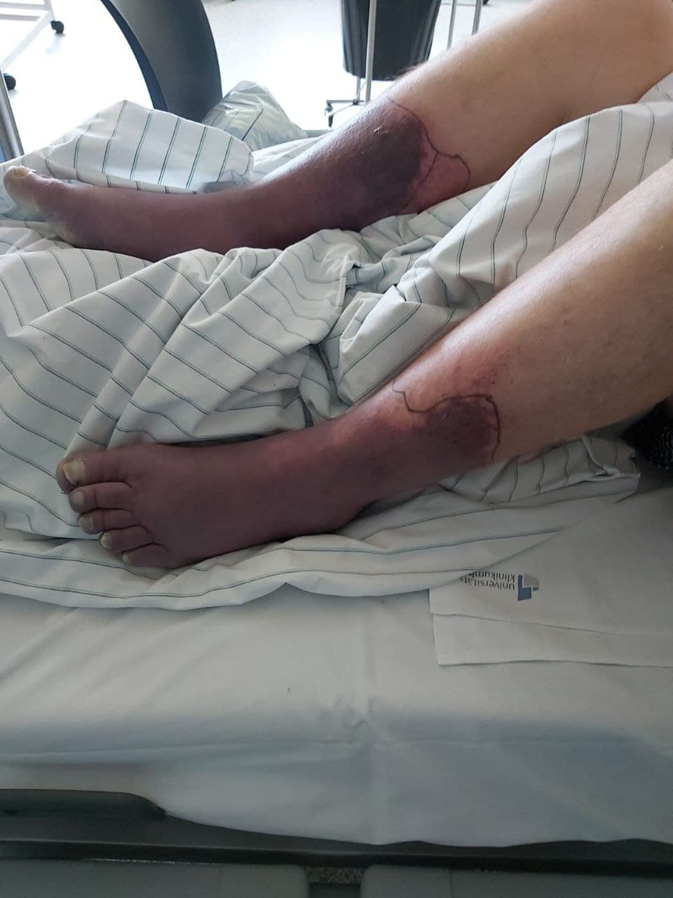 GENimpfmord NRW 21.1.2022: Person GENgeimpft
                  stirbt an gigantischen Thrombosen an den Beinen, Foto
                  2