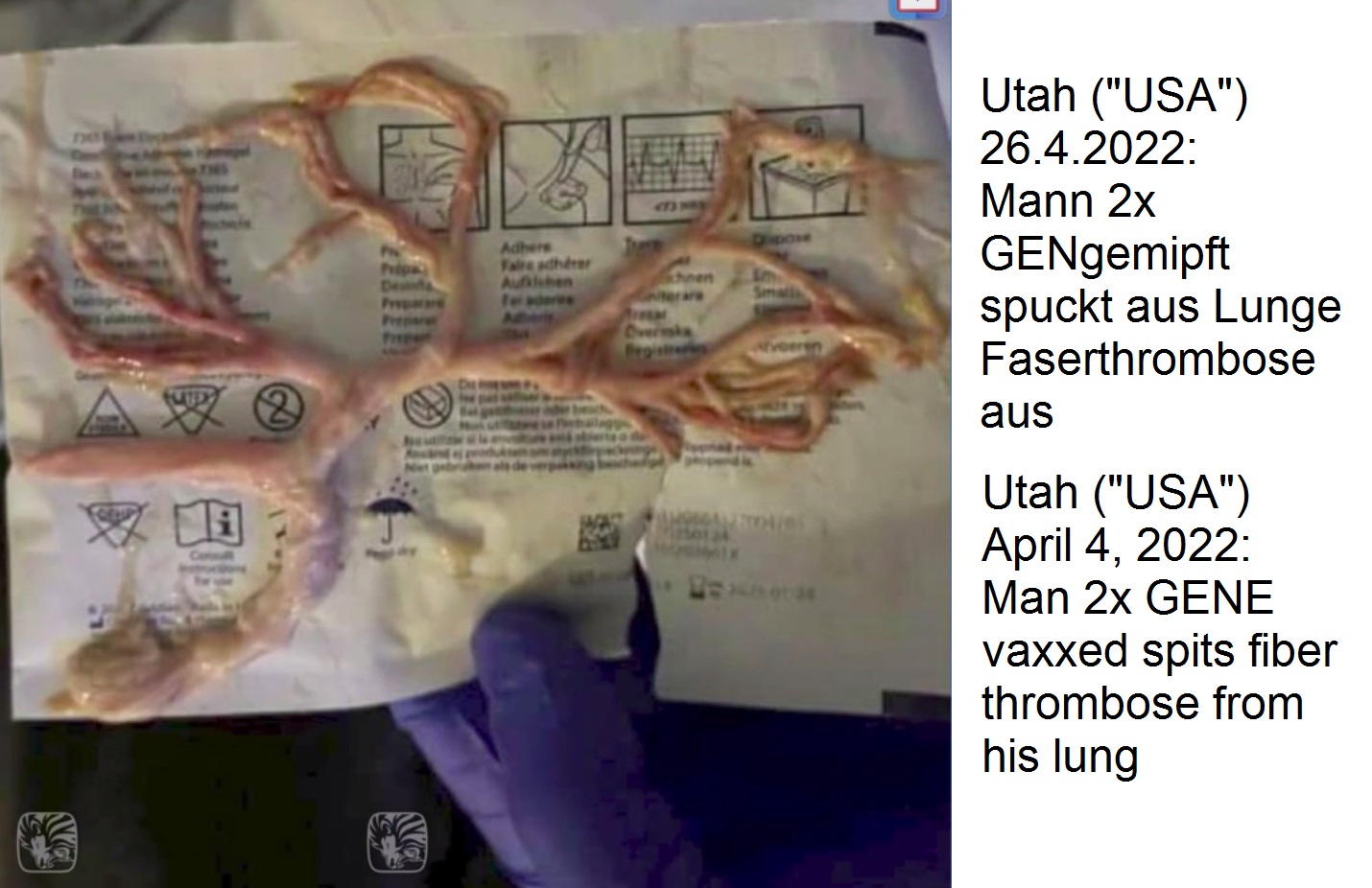 GENimpfschaden in Utah
                      ("USA") 26.4.2022: 2x GENgeimpfter Mann
                      (32) spuckt Faser-Thrombose in Form der Lungenwege
                      aus: Utah ICU Nurses Try To Hide Fibrous Clot
                      Coughed Up By Jabbed 32 Year Old