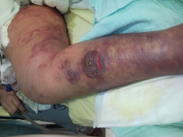 Rhabdomyolyse