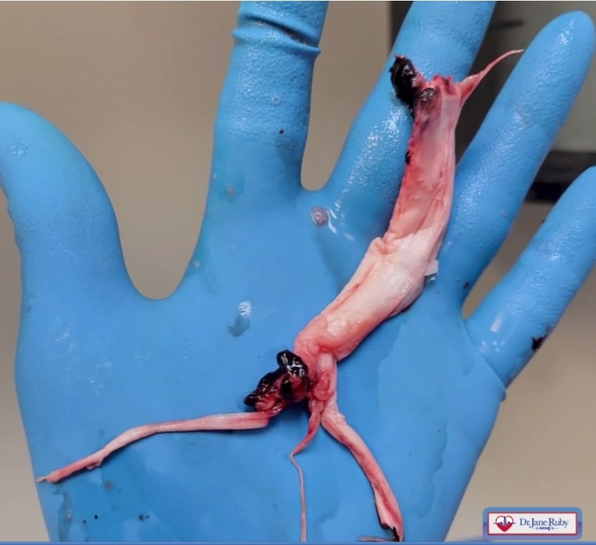 SCHLANGENGIFTimpfschaden "USA"
                    13.5.2022: Weisses Faserblutgerinnsel von
                    Einbalsamierer Richard Hirschmann