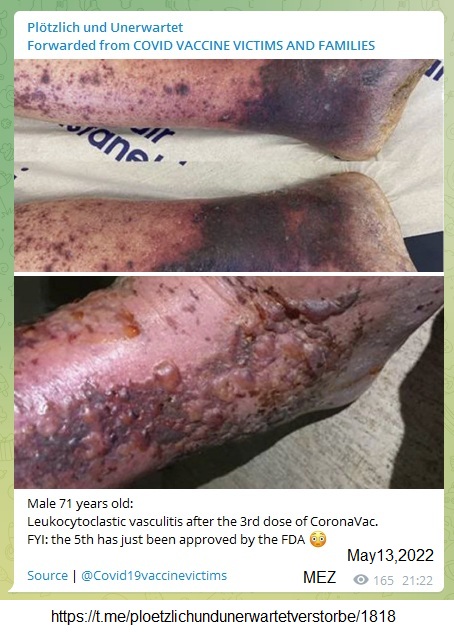 SCHLANGENGIFTimpfschaden
                    "USA" 13.5.2022: Bl�schenausschlag mit
                    abgestorbenem, nekrotischen Gewebe: Male 71 years
                    old: Leukocytoclastic vasculitis after the 3rd dose
                    of CoronaVac