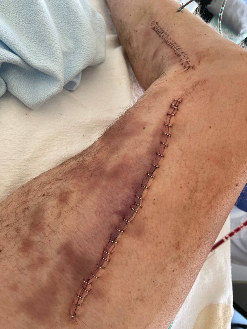 SCHLANGENGIFTimpfschaden ohne Ort 1.8.2022:
                  Beinthrombose rausgeholt