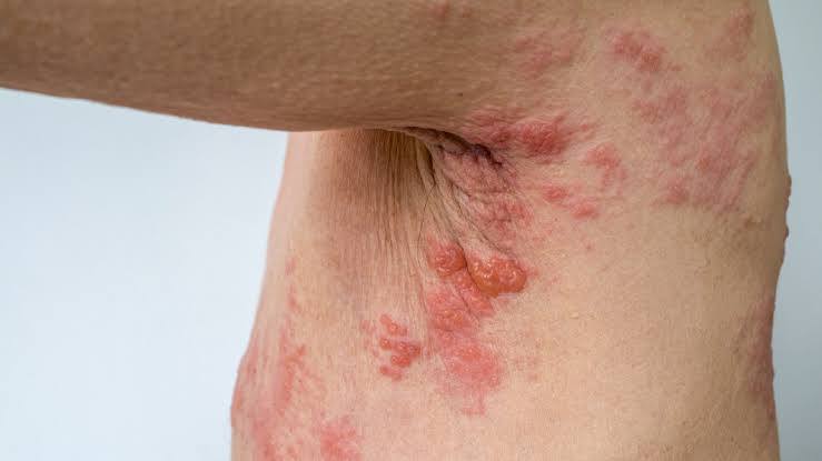 SCHLANGENGIFTimpfschaden Studie in Europa
                  7.8.2022 "Coronaimpfung" reaktiviert
                  G�rtelrose Studie des JEADV Journal of The European
                  academy of Dermatology and Venereology