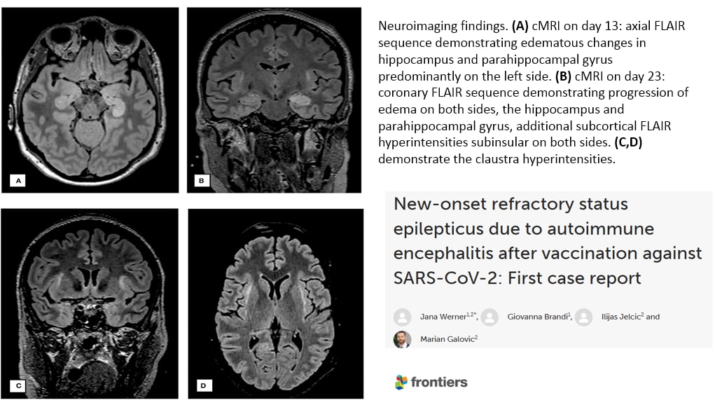 SCHLANGENGIFTimpfschaden ohne Ort 6.9.2022:
                  Hirnschaden Epilepsie nach Hirnhautentz�ndung nach
                  "Coronaimpfung"