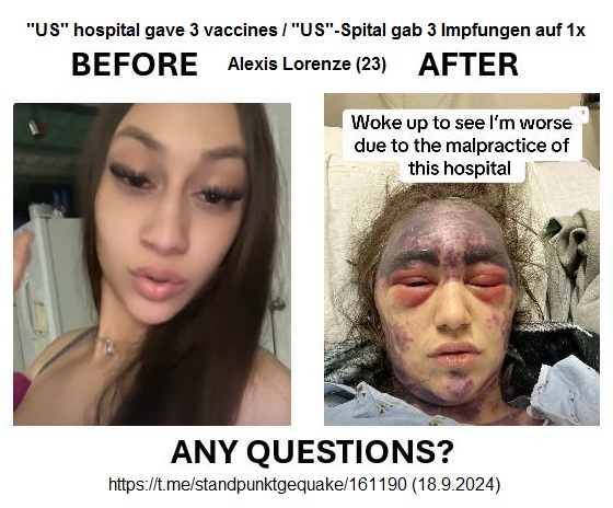 "USA" am
                                            19.9.2024: Geh NIE in ein
                                            Pharma-Spital! Spital gab
                                            ihr 3 Impfungen
                                            gleichzeitig, um
                                            "behandelt" zu
                                            werden, und nun wird sie
                                            violett: Alexis Lorenze