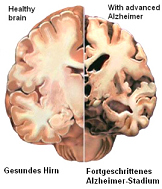 Das Alzheimerhirn hat gegenüber dem
                          normalen Hirn einen grossen Teil der Substanz
                          verloren. Quecksilber ist wesentlich daran
                          beteiligt.
