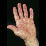 Arzneimittelallergie (Hautallergie): zum
                          Beispiel makulopapulöses Exanthem
