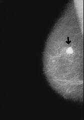 Brustkrebs und viele andere Krebsarten:
                          Blutgruppe A ist besonders anf�llig f�r alle
                          A-�hnlichen Krebsarten.