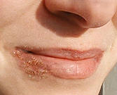 Virus Herpes simplex: Die
                              Virenanf�lligkeit bei Blutgruppe B kommt
                              bei einem Ungleichgewicht zwischen
                              Calciumspiegel und Magnesiumspiegel.