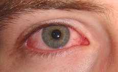 Konjunktivitis
                      (Bindehautentz�ndung) kann man gem�ss Dr. Peter
                      D'Adamo mit Tomatenscheiben behandeln