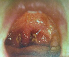 Mononukleose tritt
                      mehr bei Blutgruppe 0 auf