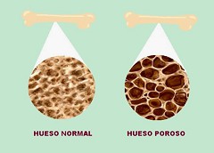 Osteoporosis cura con b�rax