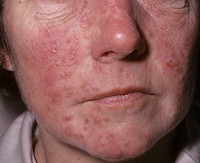 Ros�cea
                      en la cara cura con b�rax