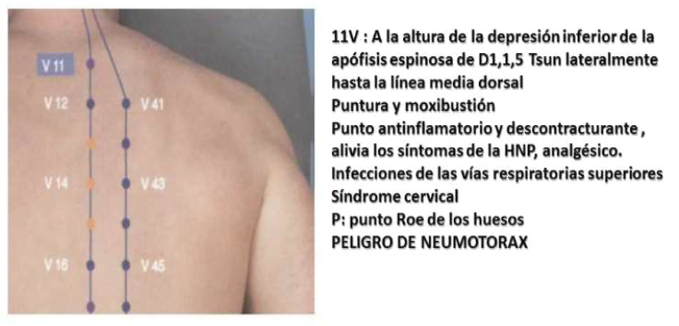 Puntos Lumbagos con punto V11