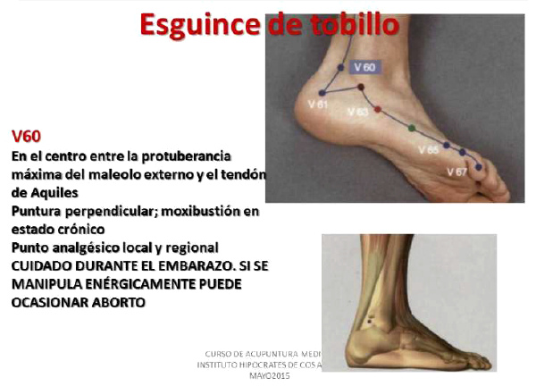 Esguince de tobillo, punto V60