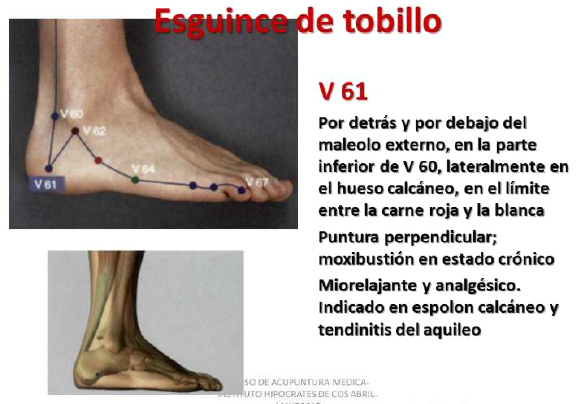 Esguince de tobillo, punto V61