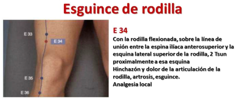Esguince de rodilla con el punto E34