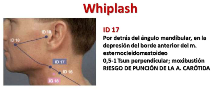 Traumatismo cervical con el punto
                              ID17