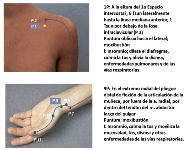 Insomnio con los puntos P1+P9