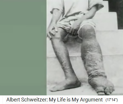 Lambarene, Patient mit Elefantiasis