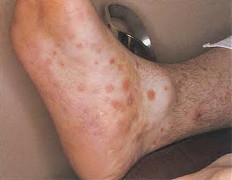 Syphilisgeschw�re an Fuss und Bein