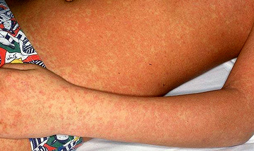 Masern
                sollten die Kinder "durchmachen", um sp�ter
                die Antik�rper an die eigenen Kinder weiterzugeben